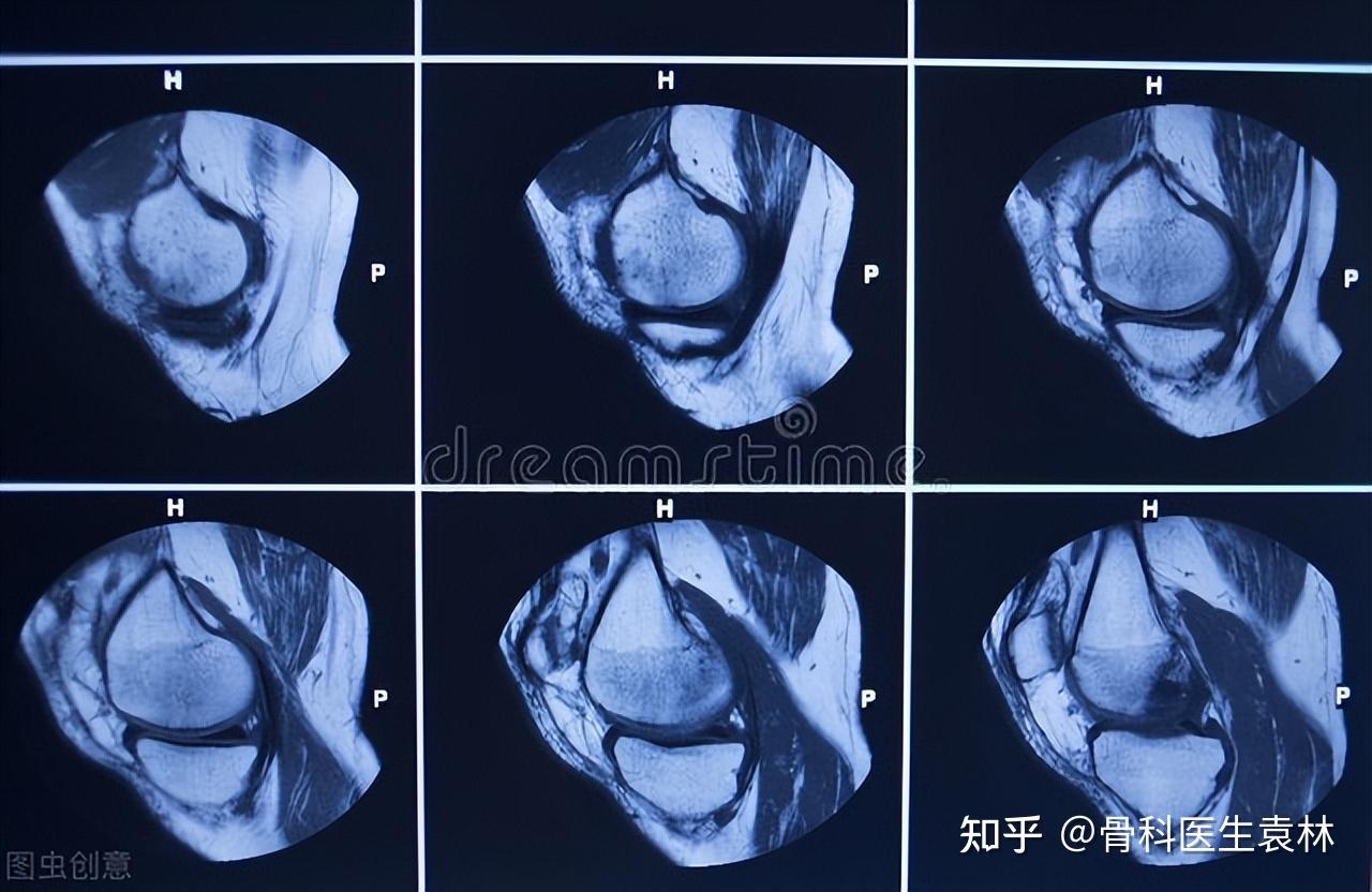 外傷,半月板是包含在膝關節內的兩個新月形的楔形墊子,由纖維軟骨組成