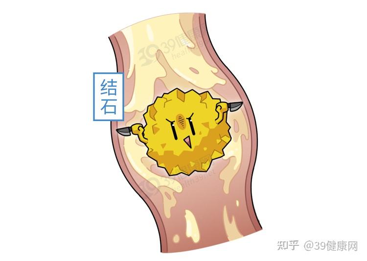 男人排出尿结石比生孩子还痛尿结石是怎么来的