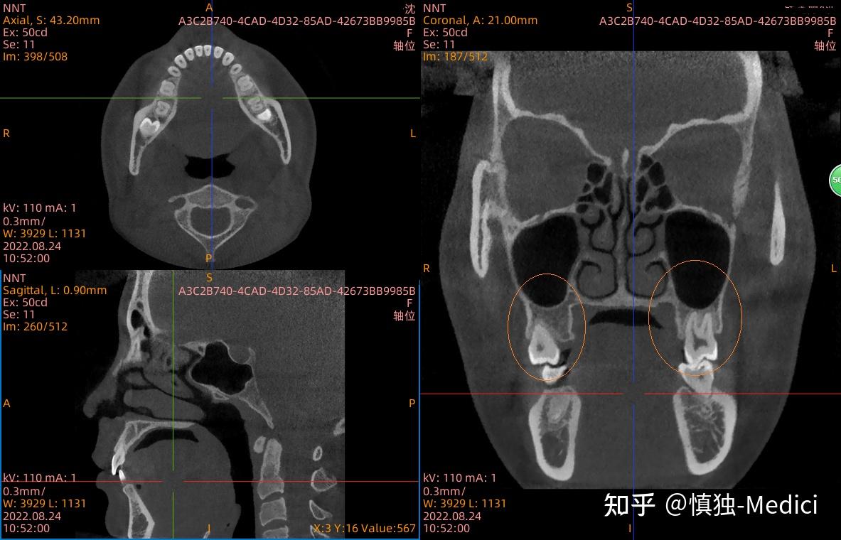 如何通过CBCT判断引起颞下颌关节问题的原因 - 知乎