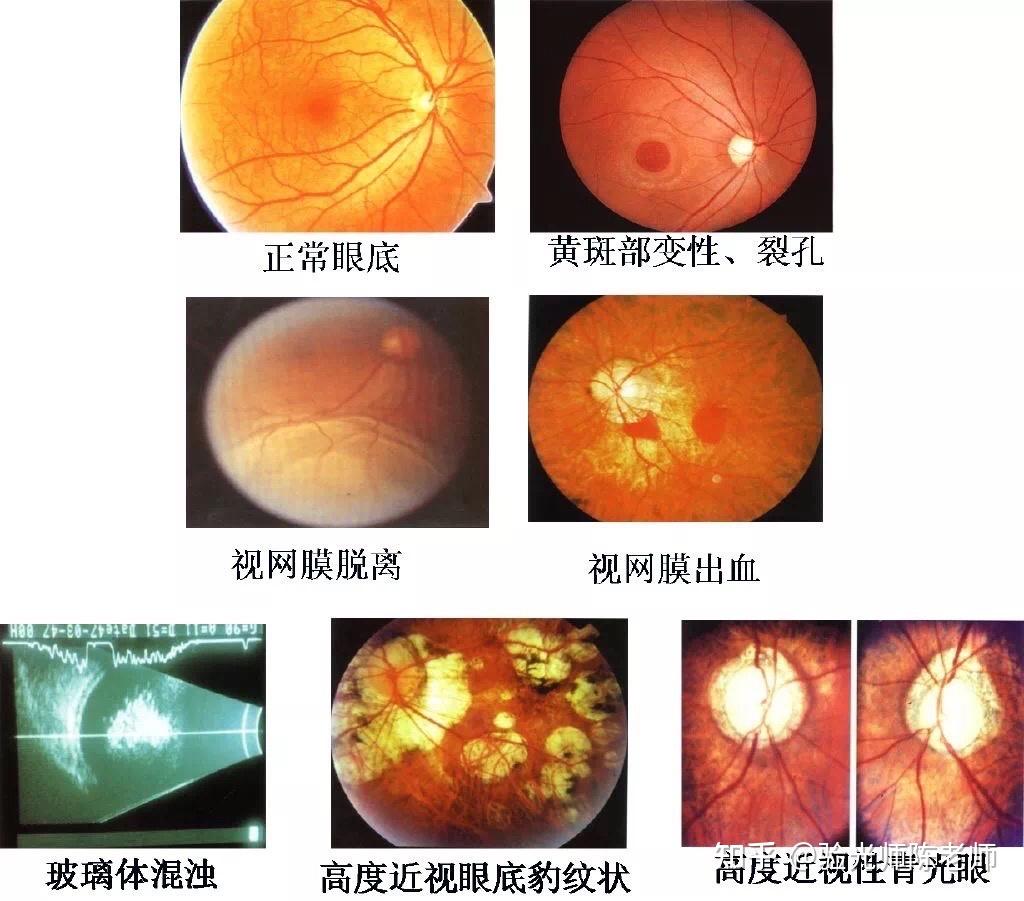近视手术可以用医保吗？|近视眼|医保|手术|近视|视力|-健康界