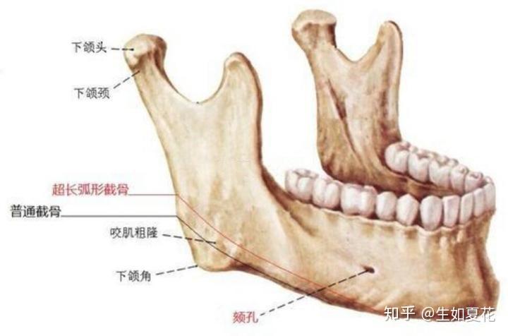 什么是下颌角磨骨手术,手术切口、风险?最全干