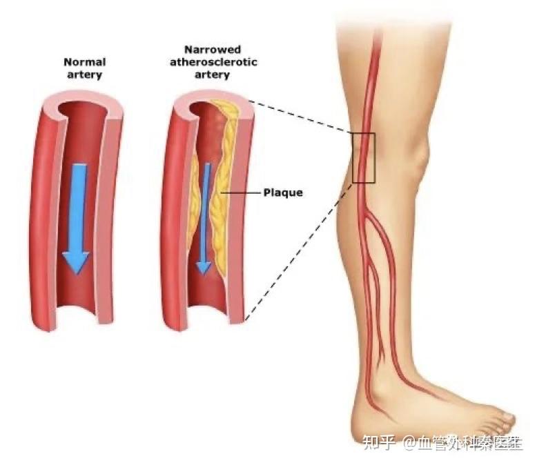 老年人腿脚发凉发麻怎么办?小心下肢动脉堵塞!——诊断篇