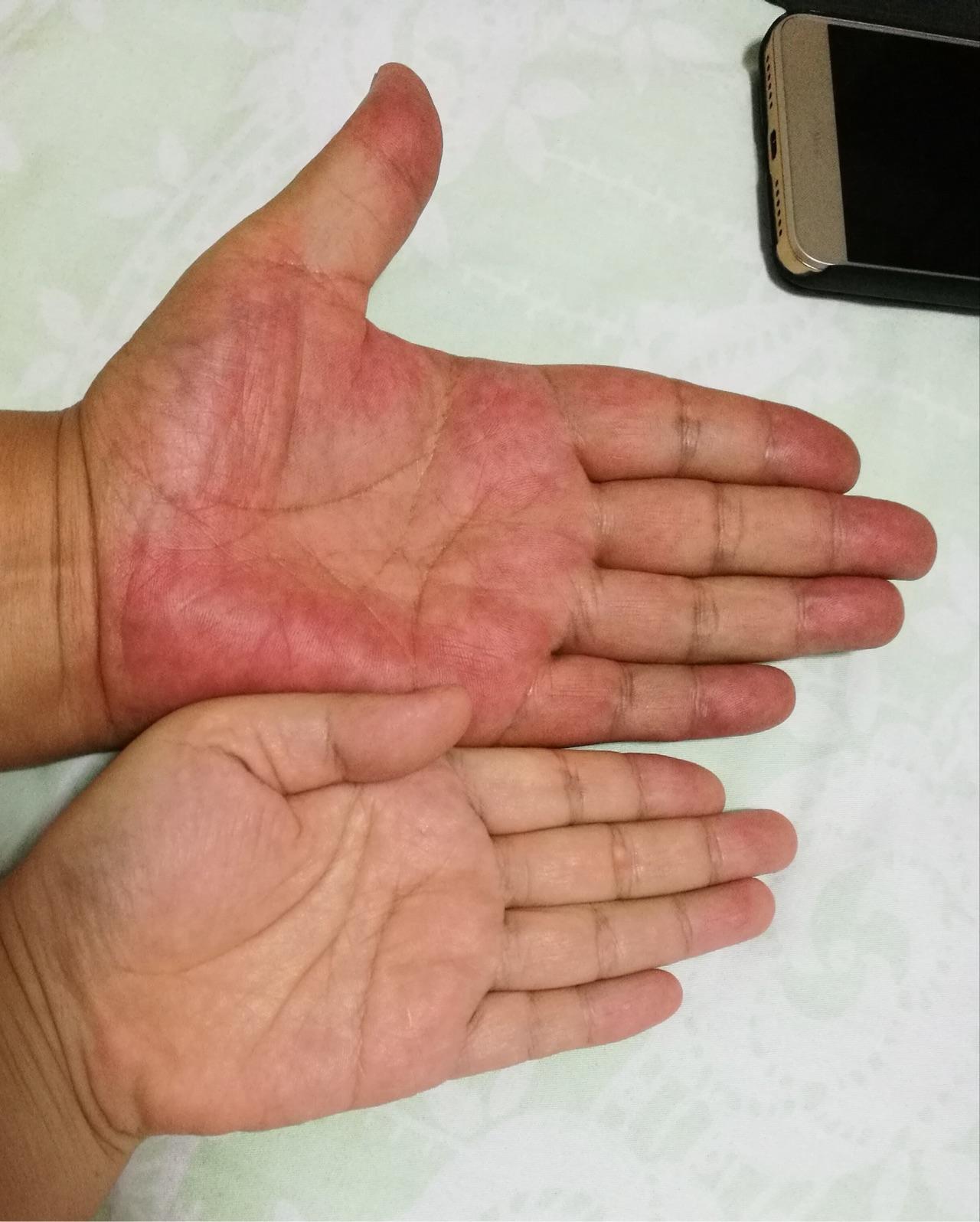 家里老人双手手掌特别红没有肿胀请问是疾病反应吗快20来天了可能是