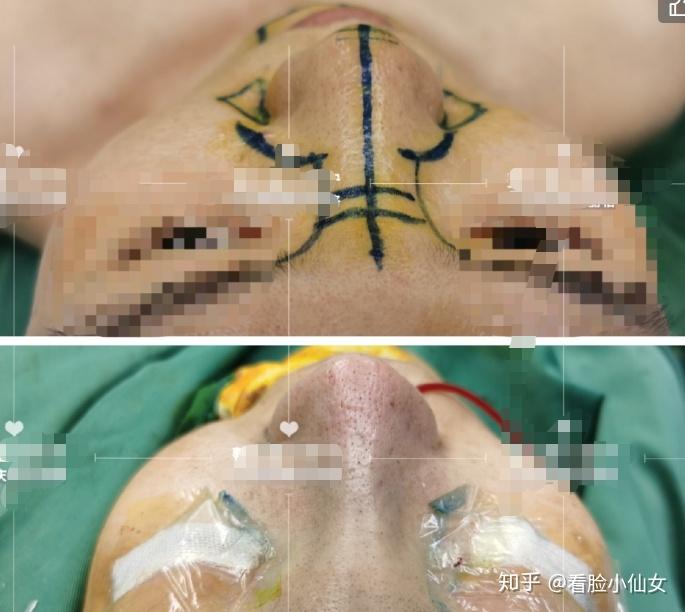 蒜头鼻图片示例 v2-3021b29df617c91bf60b2afd826cd2f1_r.jpg