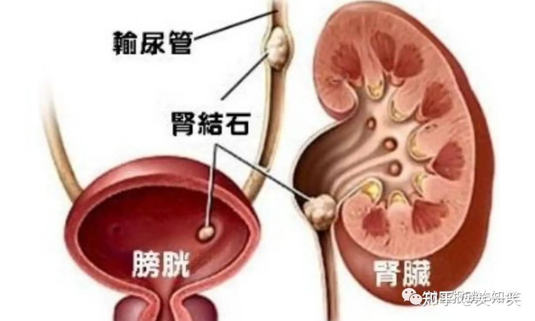 胆结石在身体的位置图图片