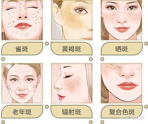 护肤知识科普雀斑黄褐斑褐青色痣老年斑这么多种色斑该如何改善