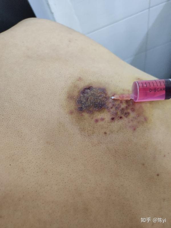 带状疱疹怎么治好的