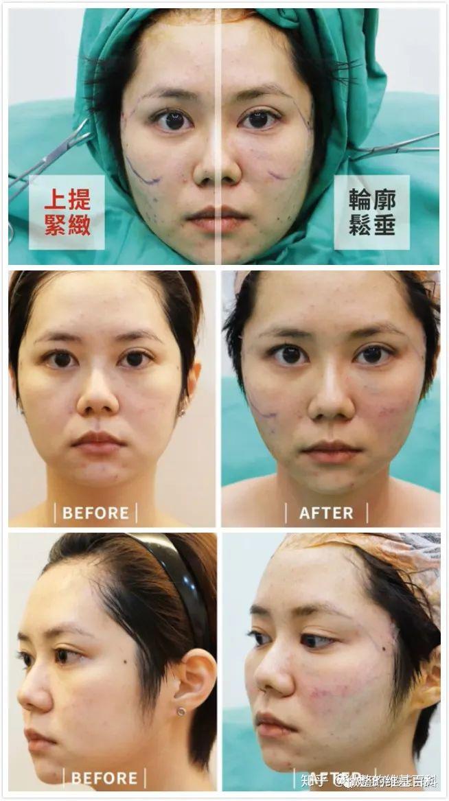 做完强生鱼骨线效果前后对比