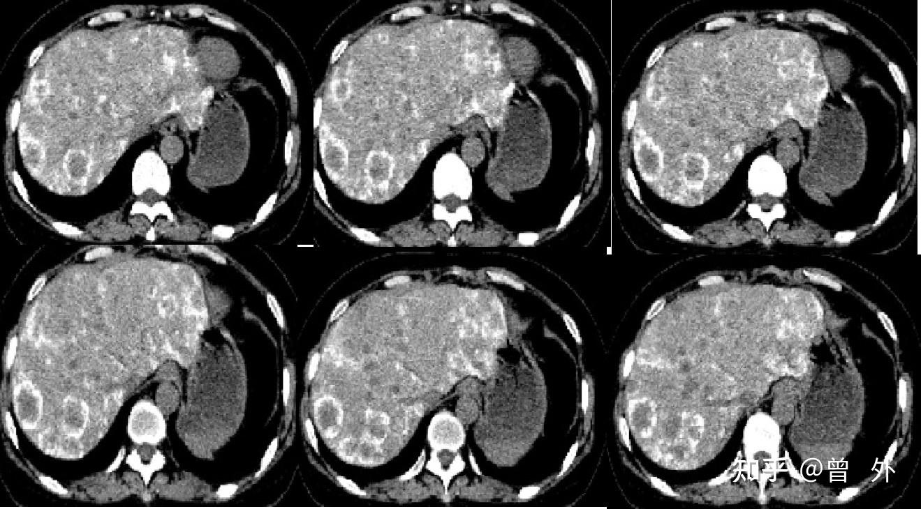 肝多发转移瘤的药物保护下介入治疗