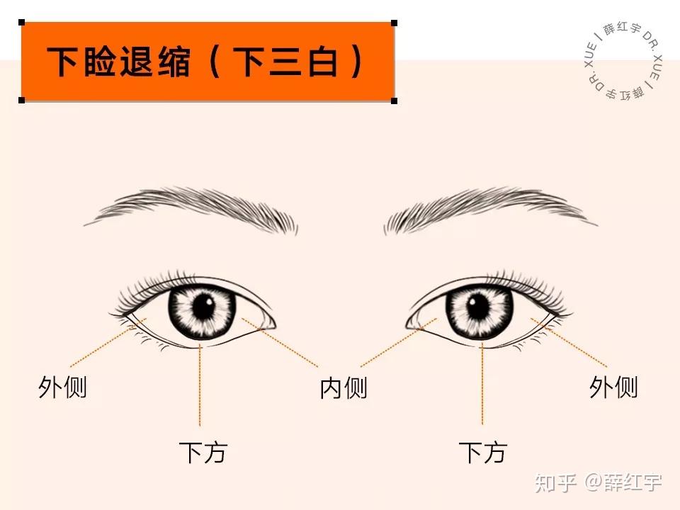 三白眼怎么办? - 知乎