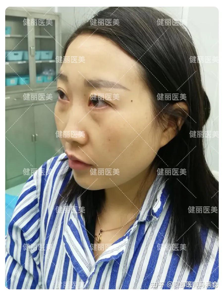 24歲的她去除眼袋後沒想到竟發生這樣的變化