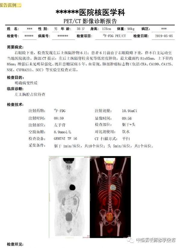 影像干货 | 核医学（18）F-FDG PET/CT报告书写规范 - 知乎