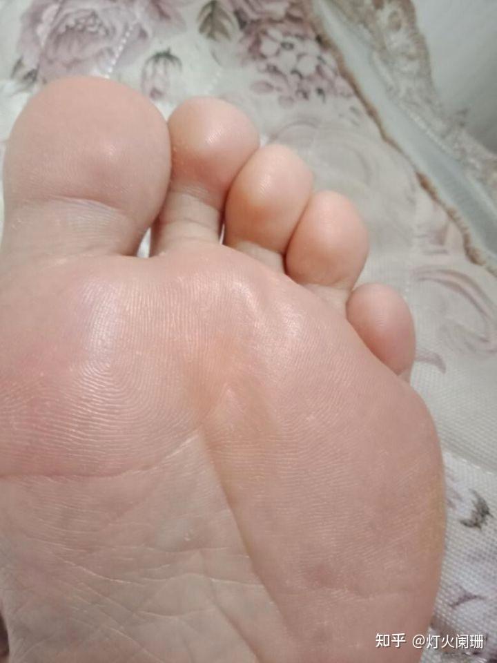 脚气如何能彻底治好