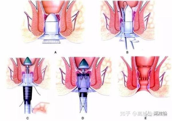 pph手术到底是什么