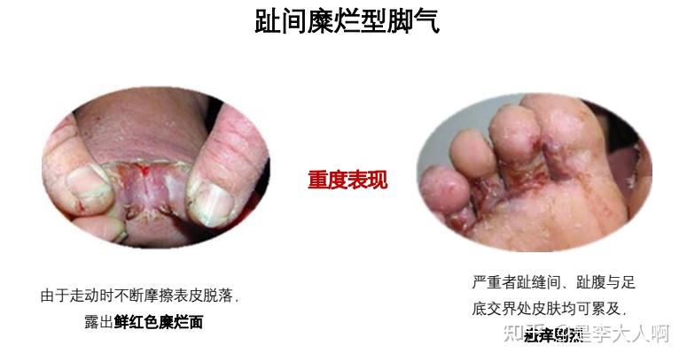 二,水泡型脚气1,症状:好发于足缘,足底部,自觉奇痒初起为壁厚饱满的小