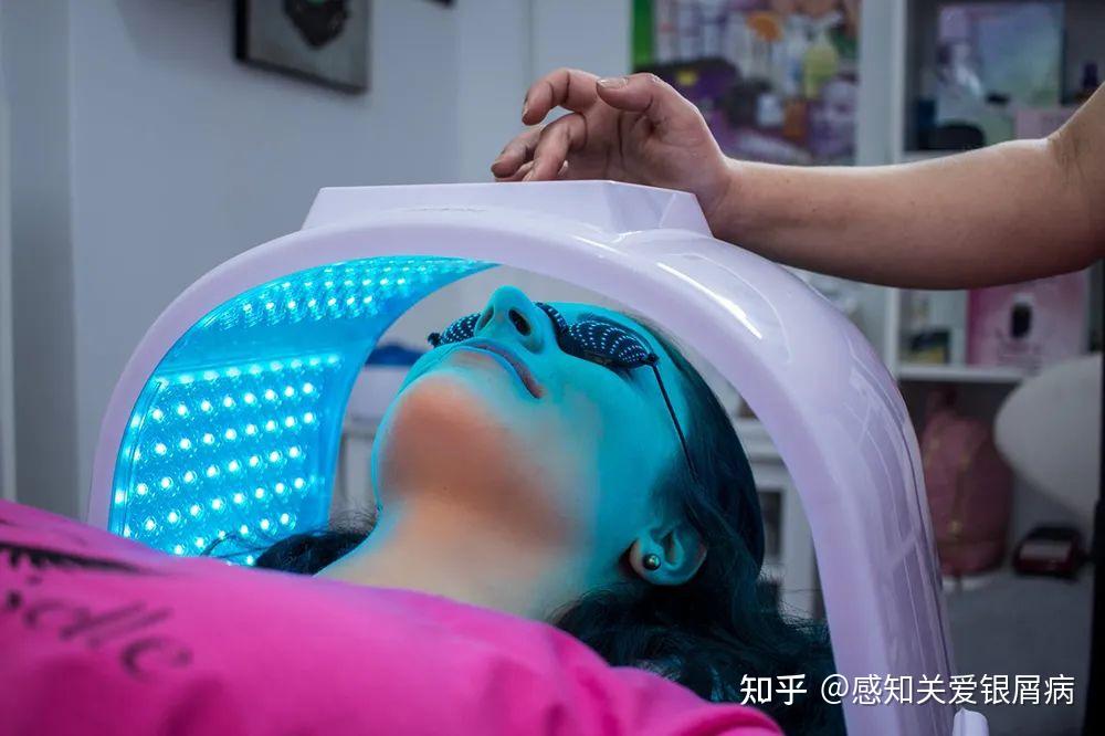 抗银频道光疗治疗银屑病的中间力量