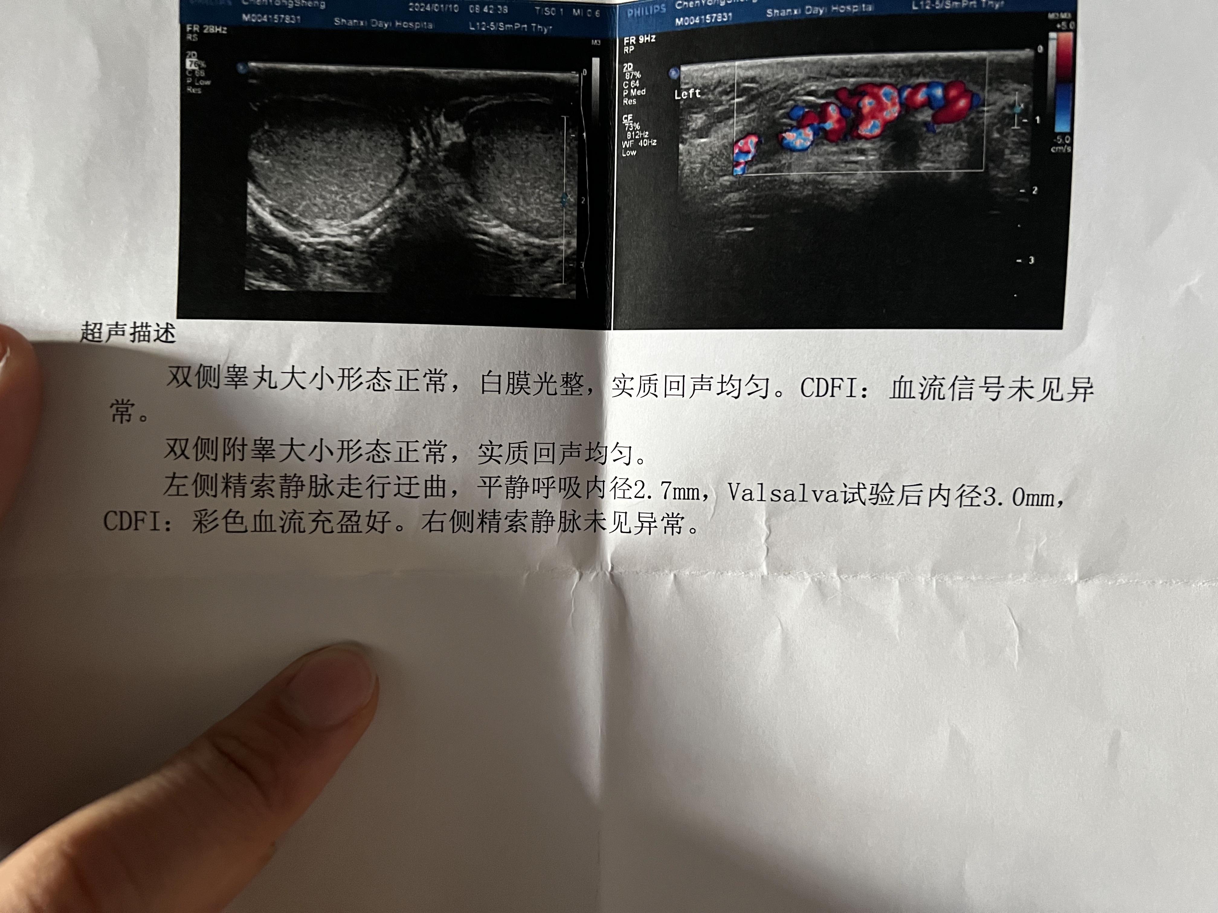 精索静脉曲张怎么自愈呢