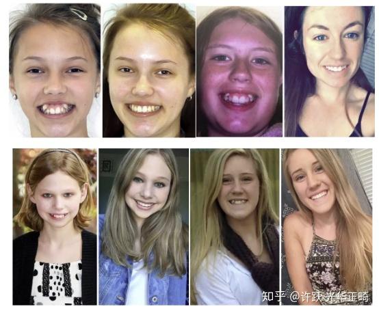 我们先通过拔除或者磨小其他牙齿的方式,为小虎牙留足空间.