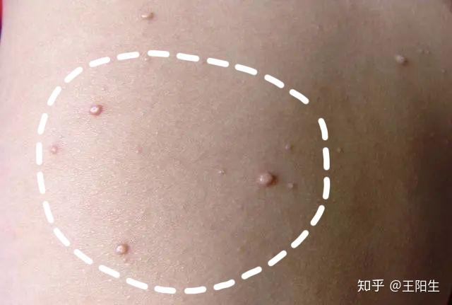 单方小技:传染性软疣 - 知乎