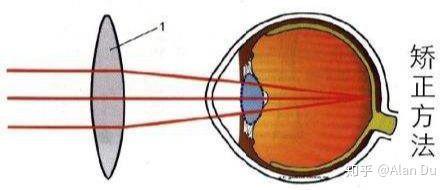 误区我年轻的时候是远视眼呢