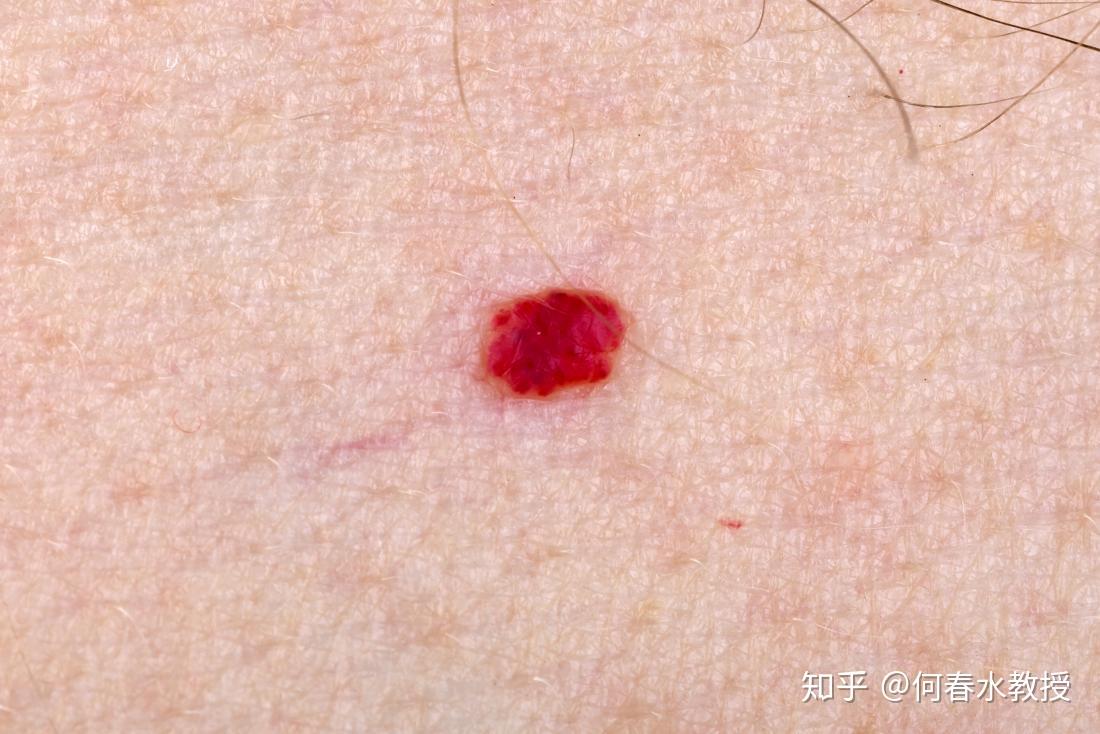 什么是皮肤血管瘤? - 知乎