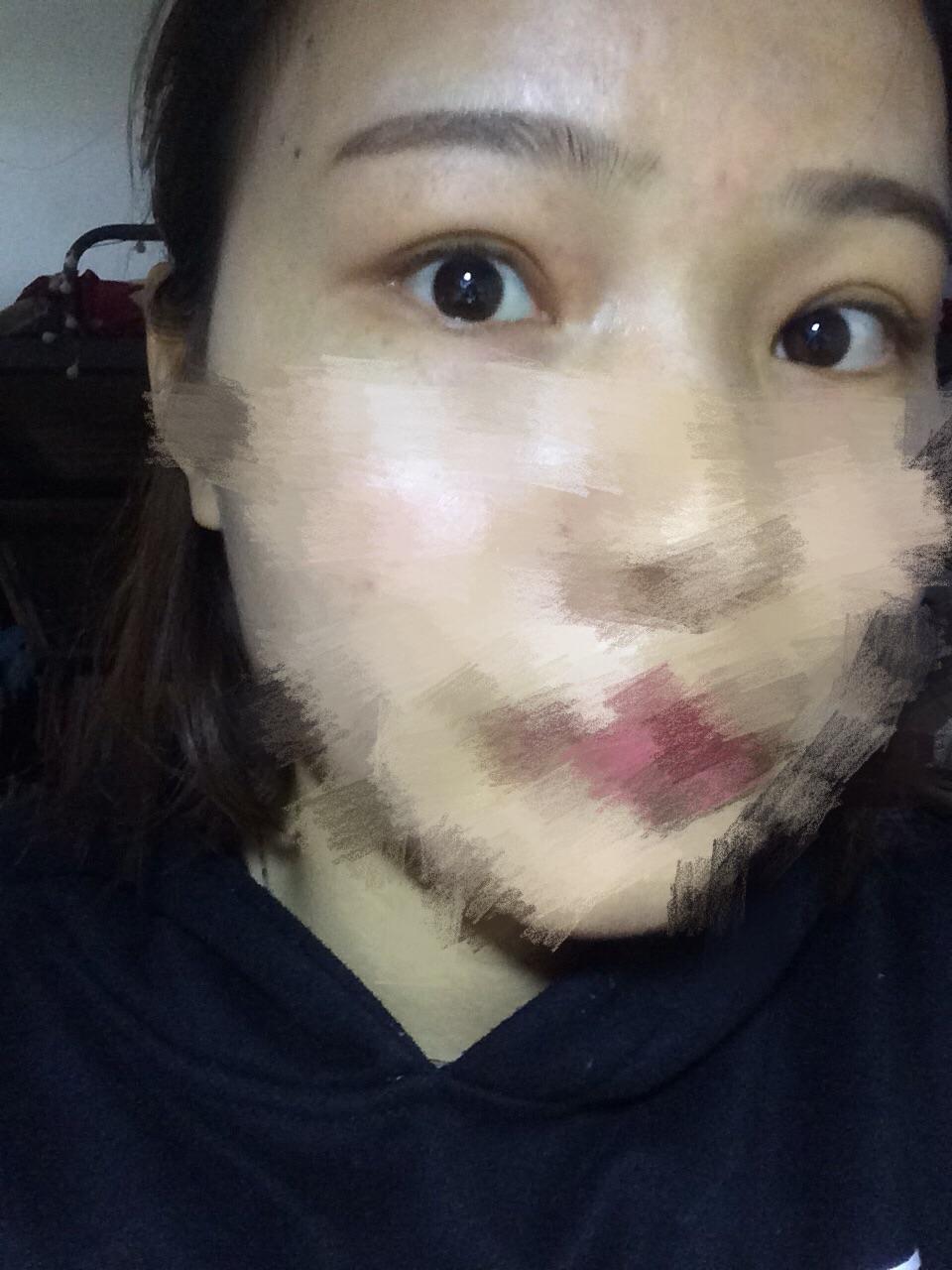 埋线双眼皮能保持多久?