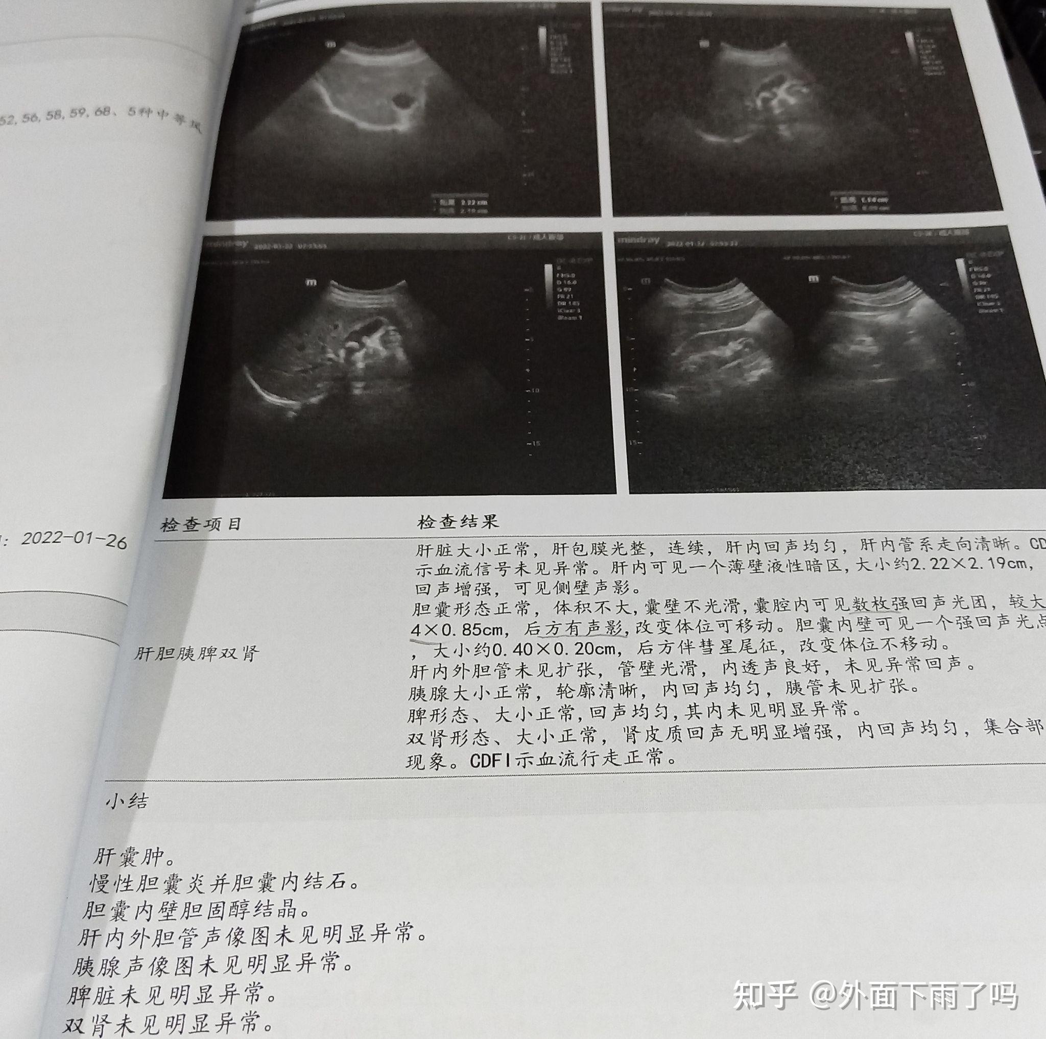 后来核磁共振时才看到这个大结石位于胆颈口,怪不得我多吃一口饭就胀