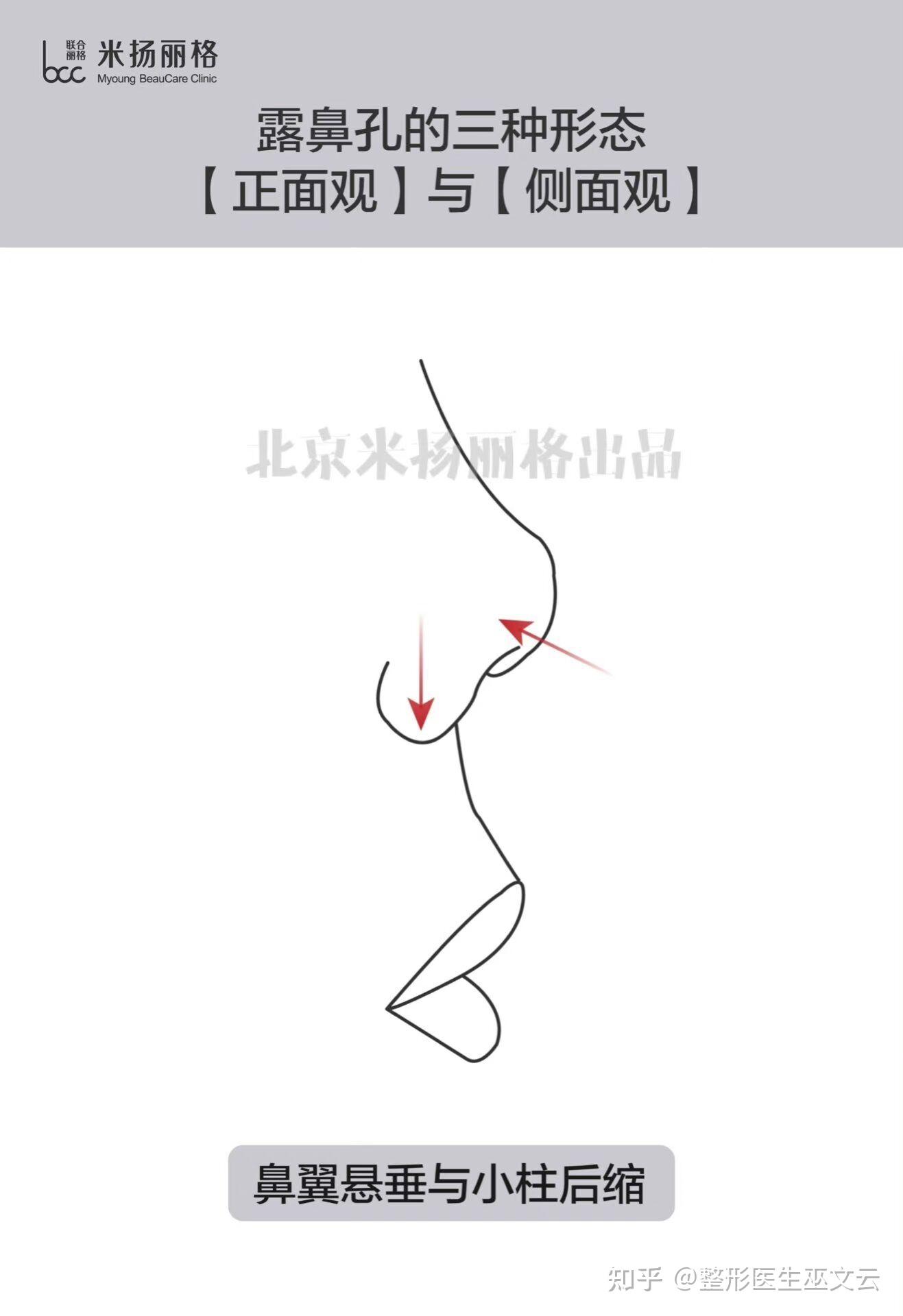 ‘朝天鼻’如何改善漏鼻孔? - 知乎
