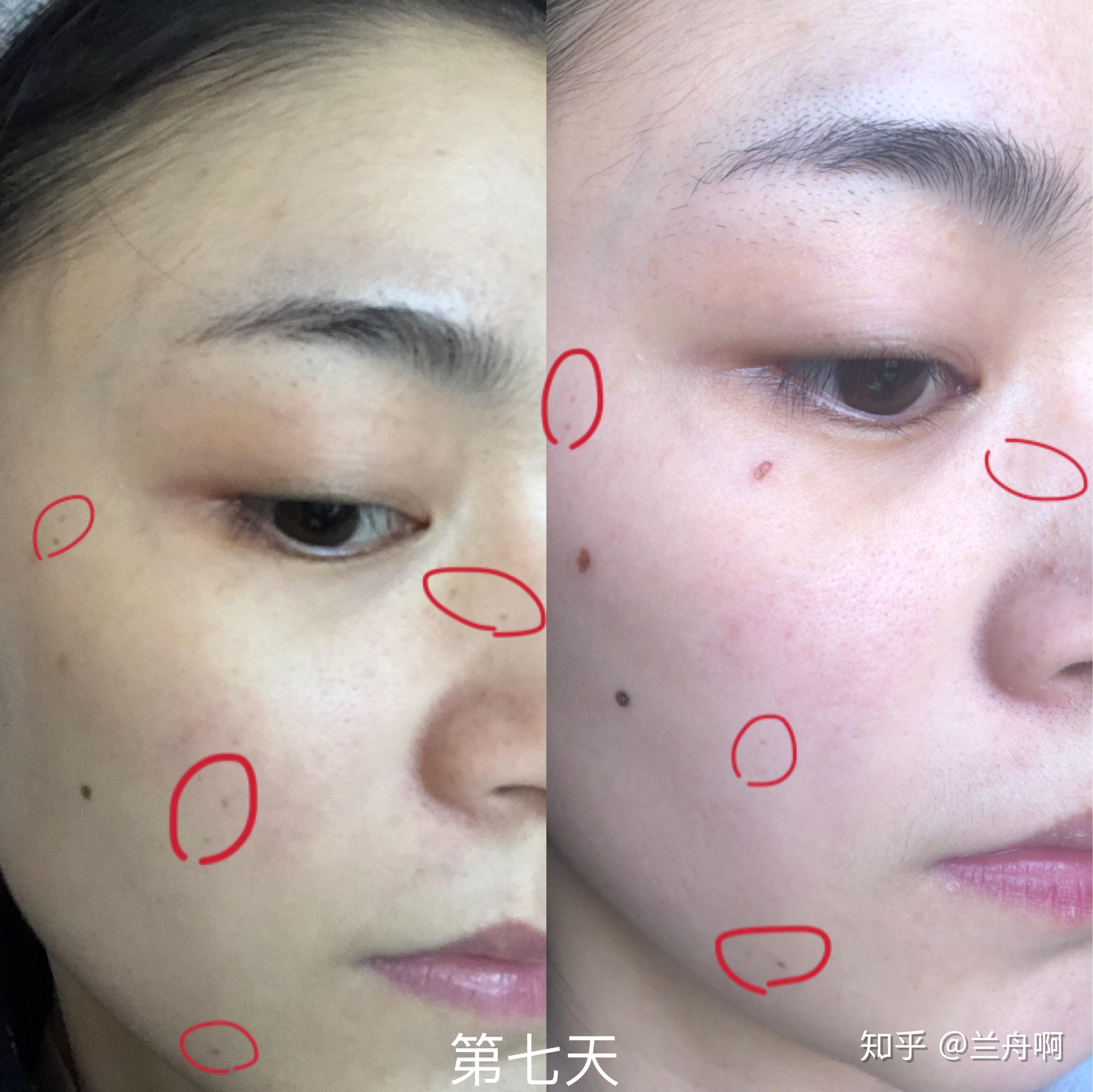 记录我的点痣历程