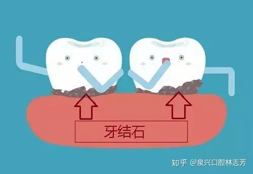 我經常刷牙為什麼還會有牙結石