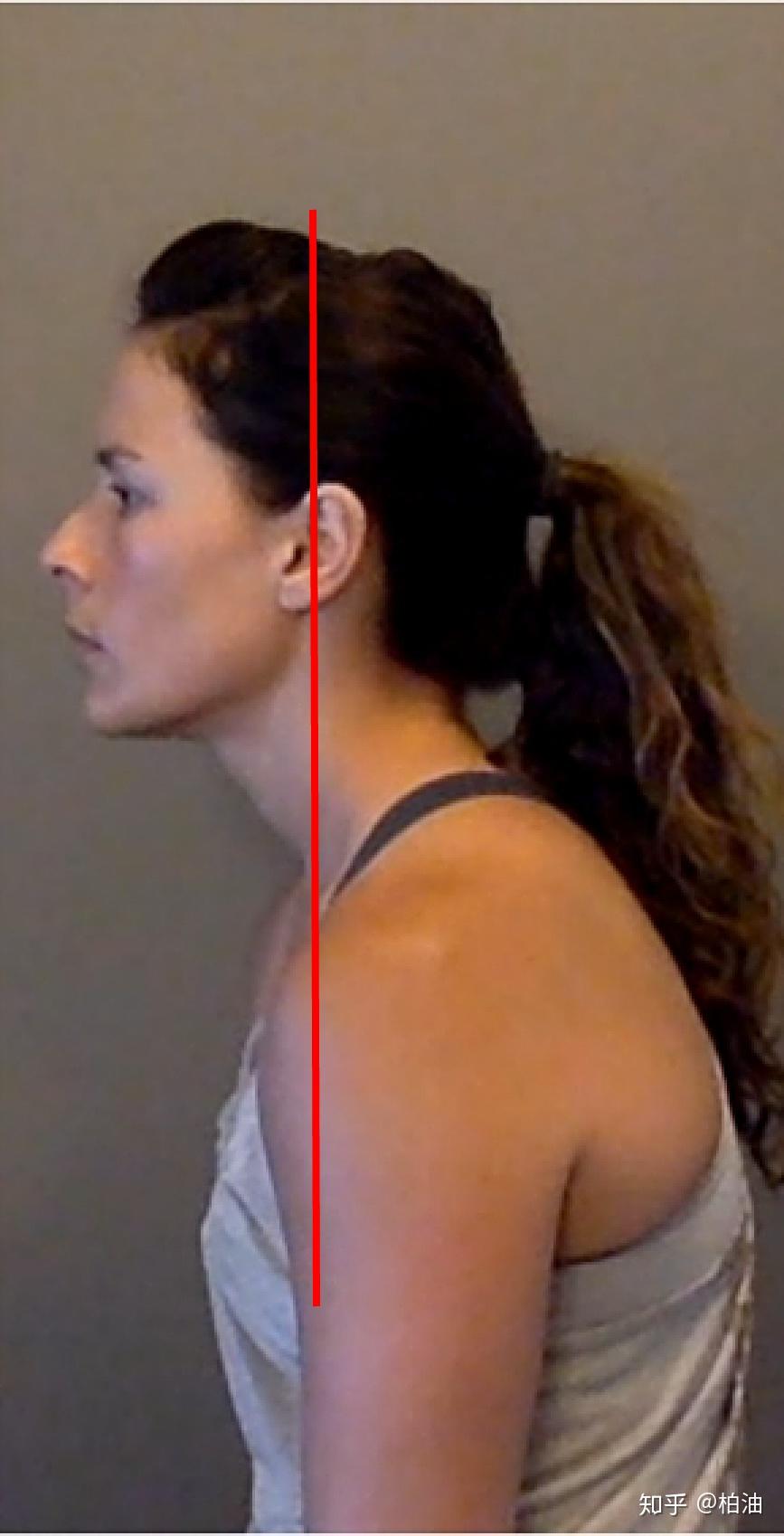 如何真正有效地改善头前倾