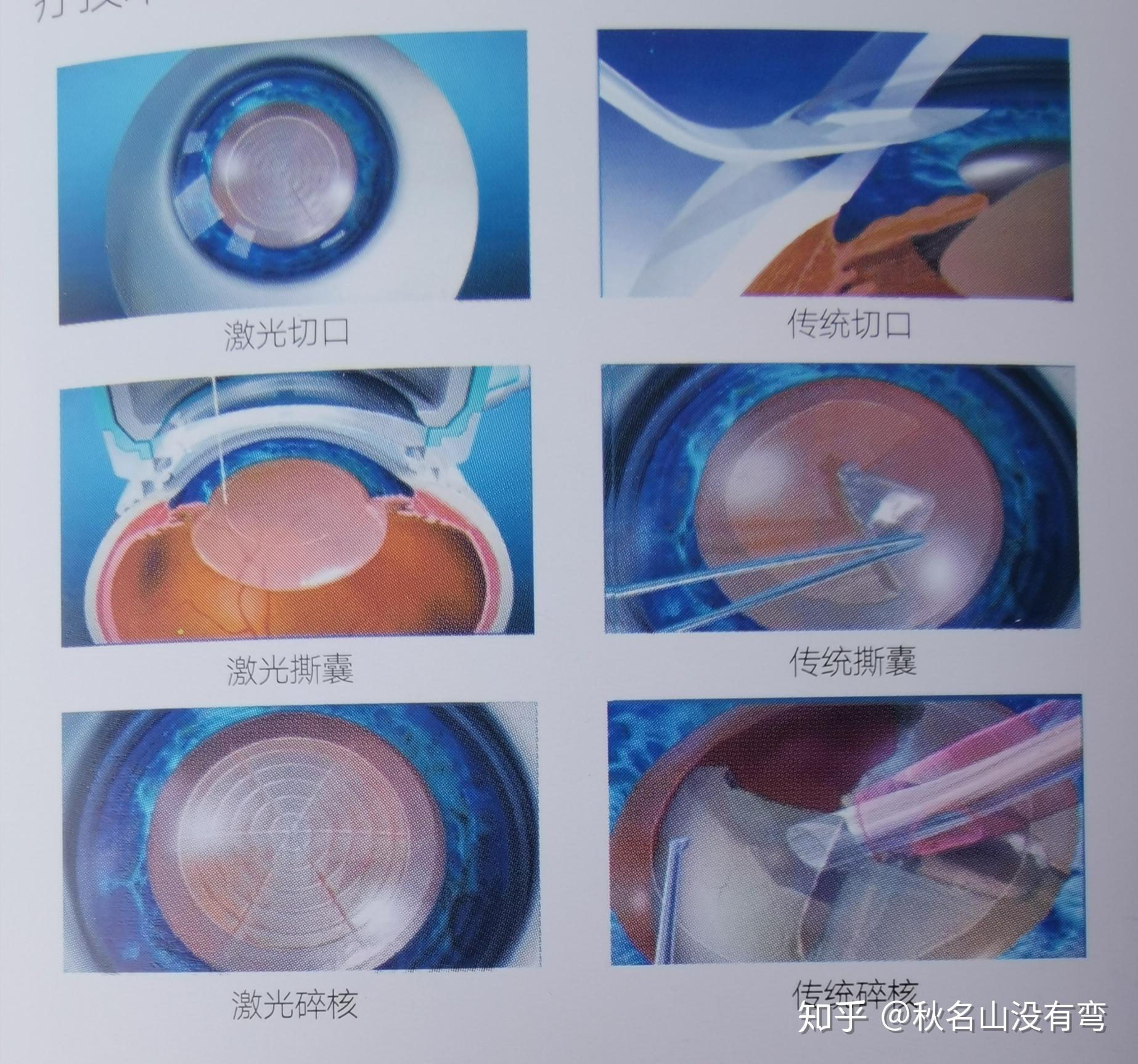 白内障手术治疗方法主要有三种:小切口白内障摘除术,超声乳化白内障