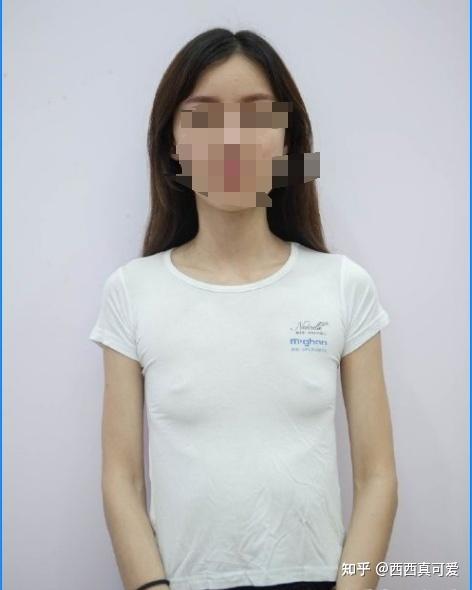 下面是手术完第四天,我自己的拍的,没有很多照片,因为当时裹着绷带也