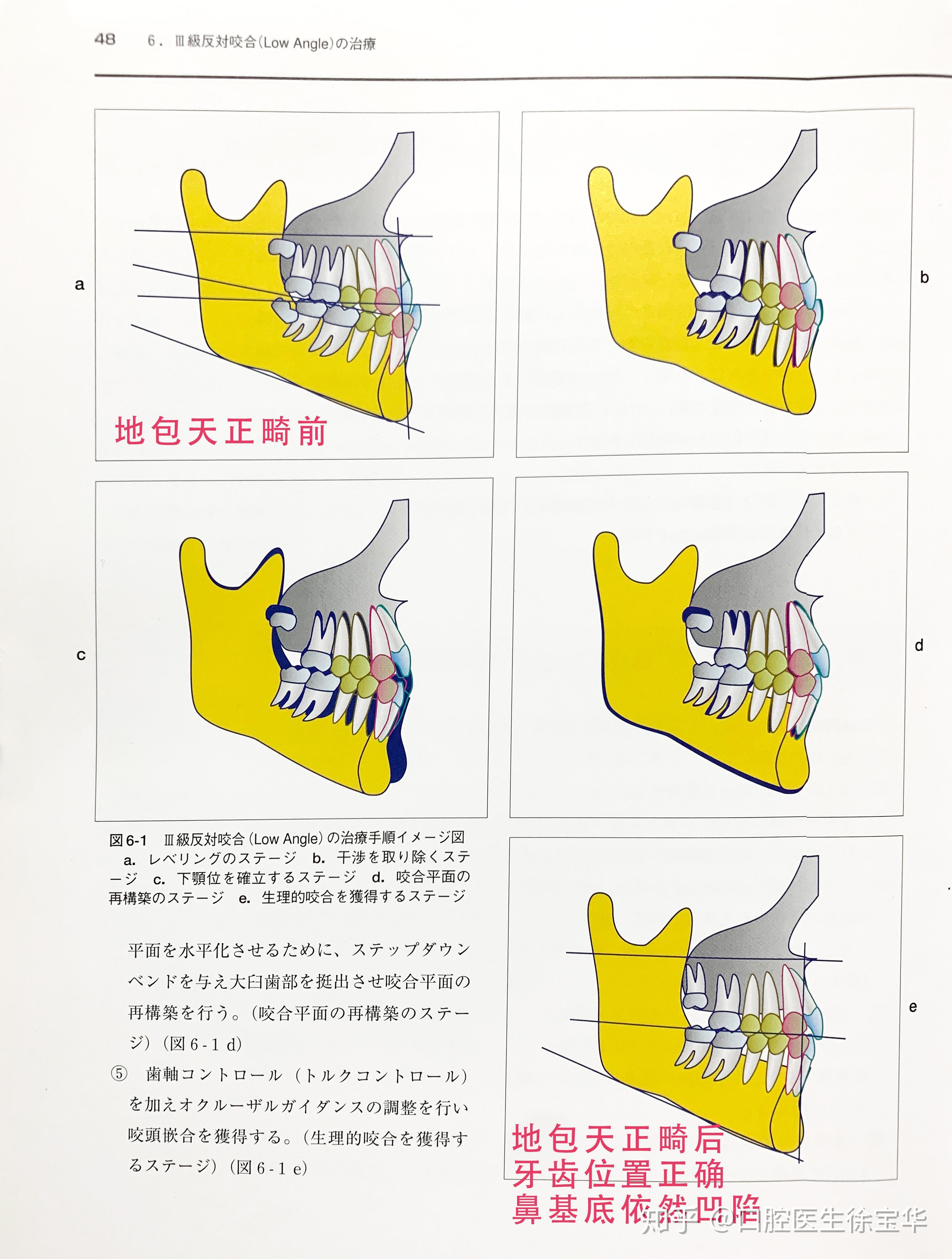 鼻基底植骨手术的发现与发展