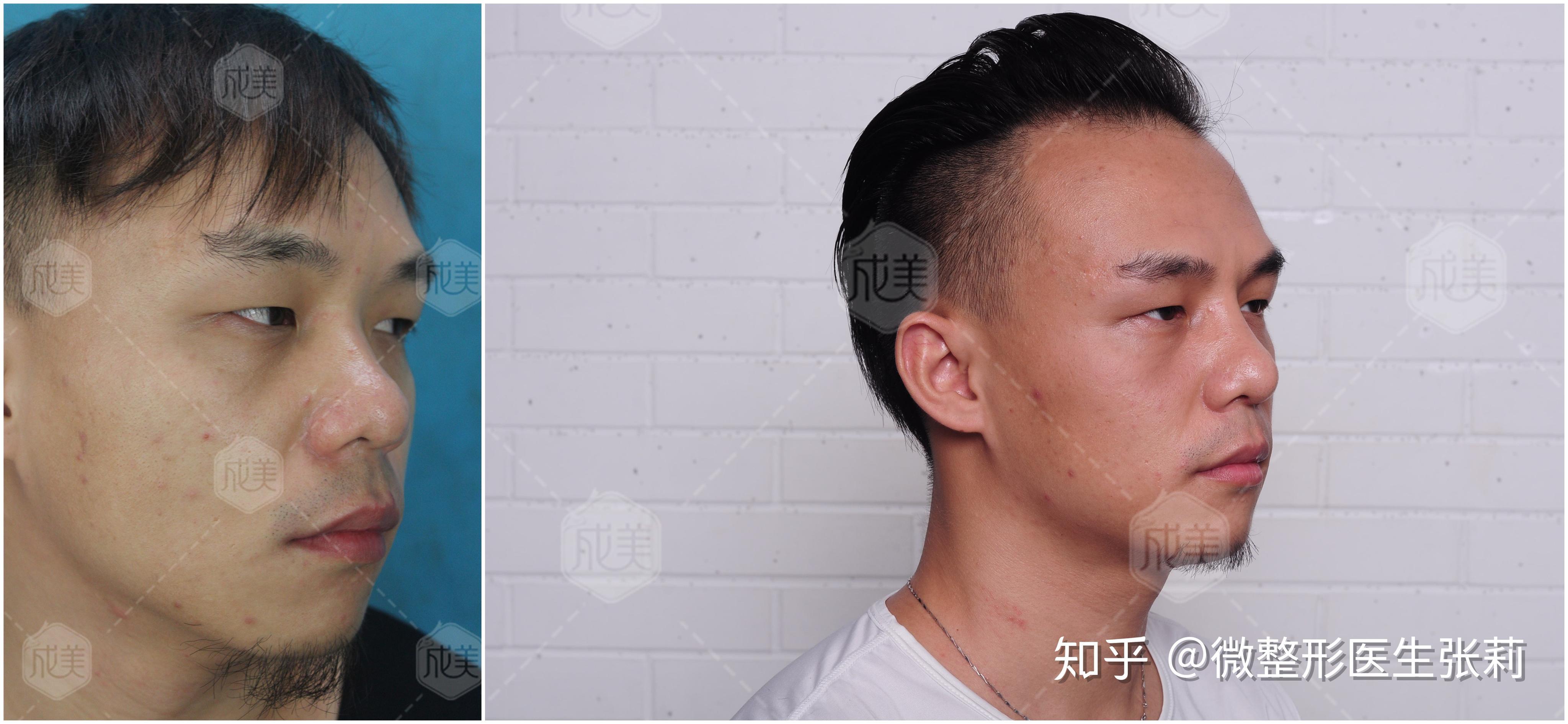 额头扁平,假体填充好还是自体脂肪填充好?