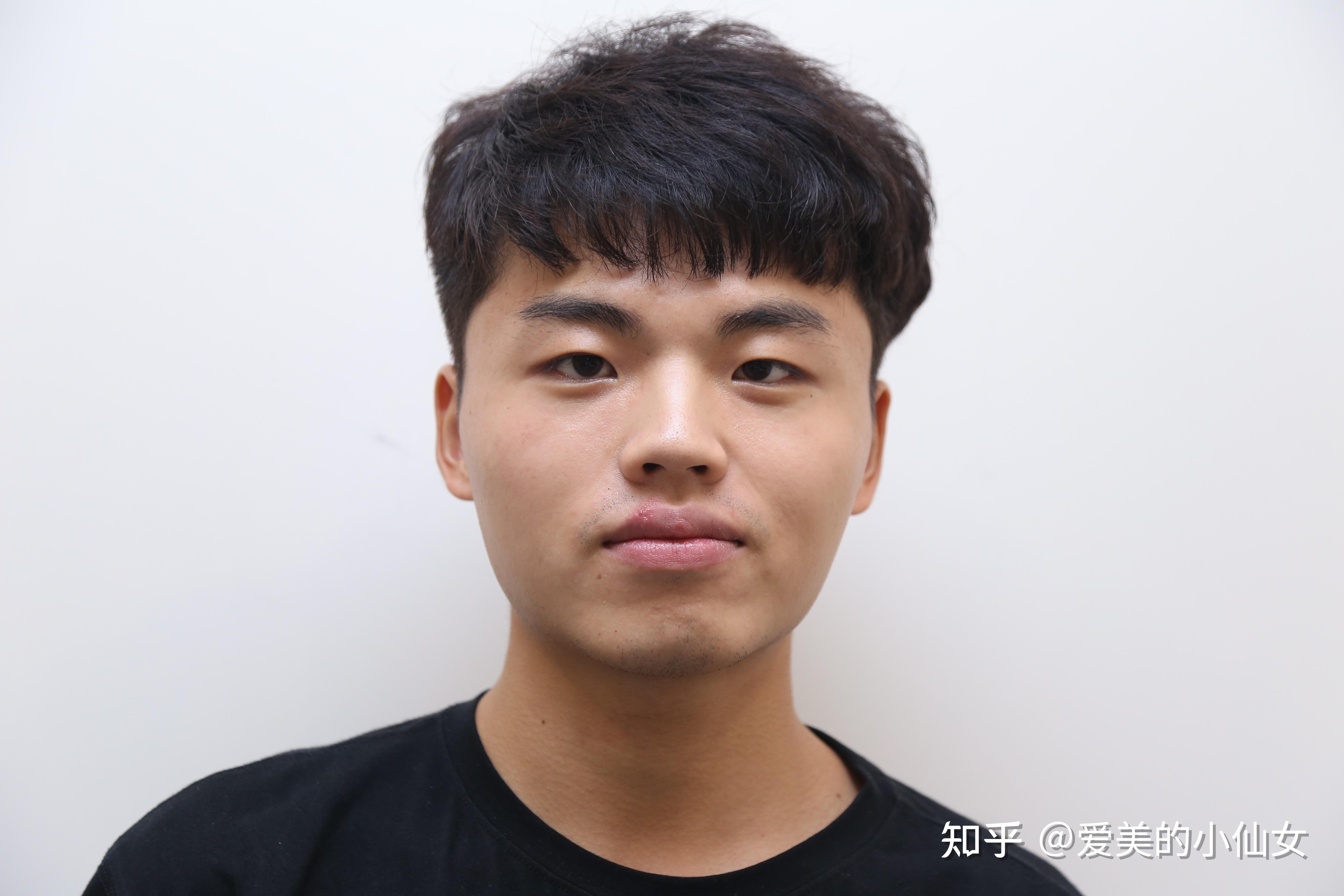 何晋龙案例分享做完颧骨手术效果怎么样