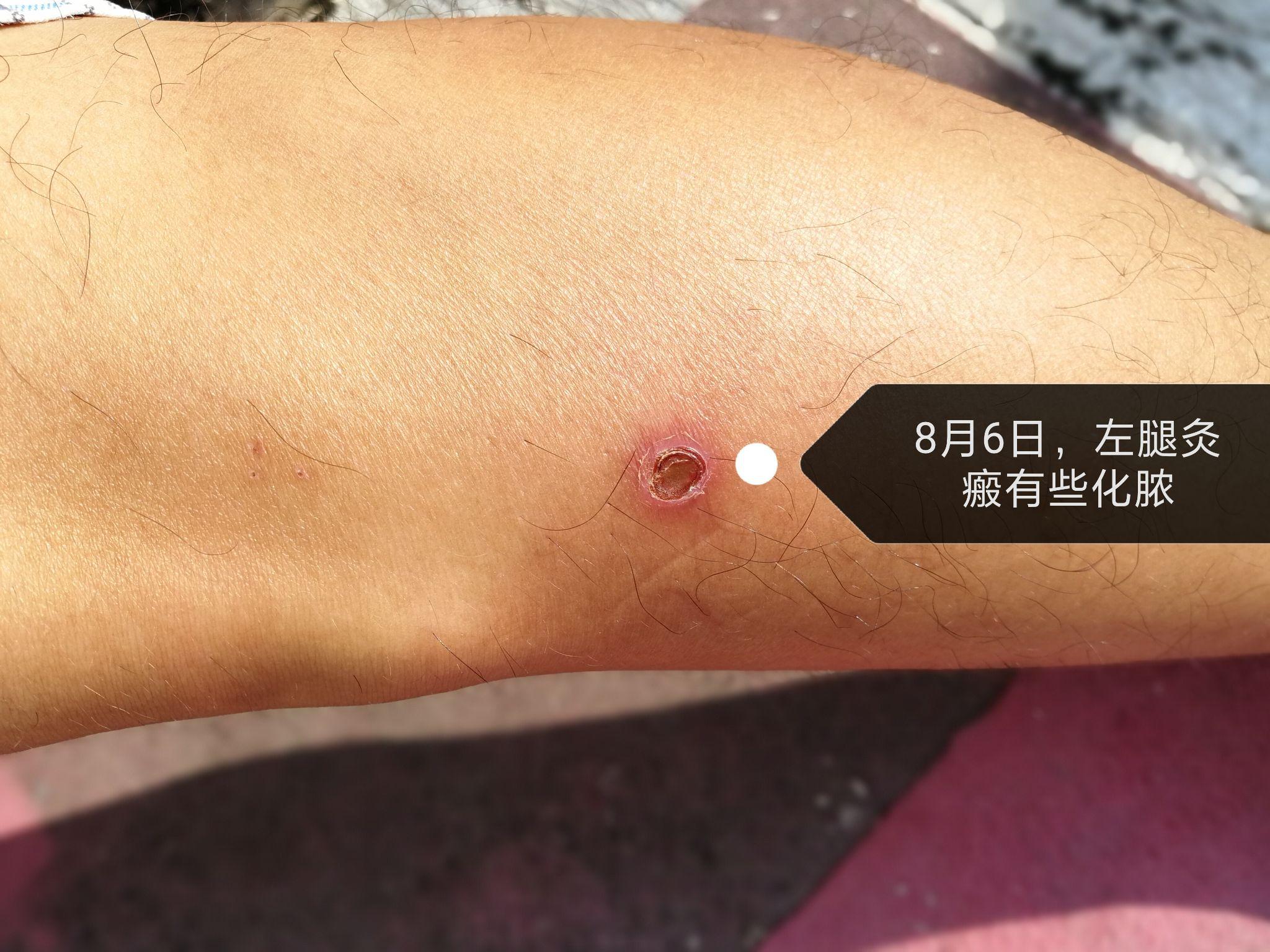 足三里瘢痕灸酸爽得不得了