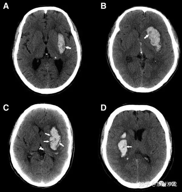 ct图像中脑出血血肿扩大的十个征象(上)
