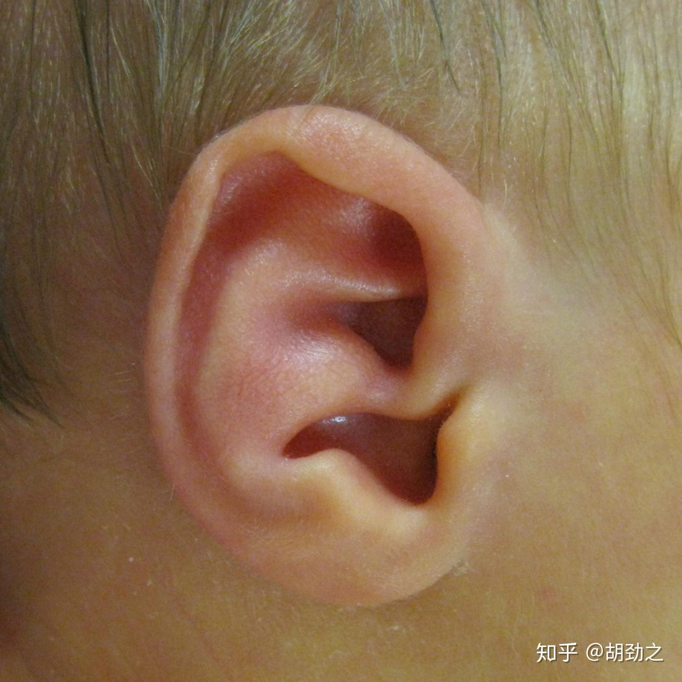 Conchal Crus 耳(耳廓形态) 知乎
