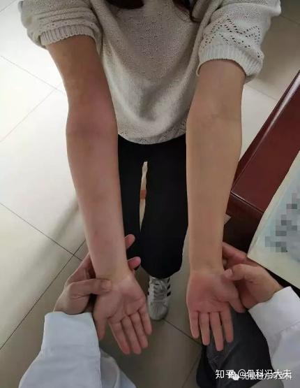 肘关节内翻畸形,手术矫形恢复正常外观!