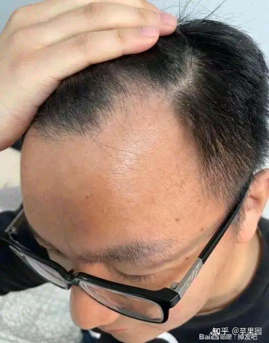 男性额角出现M型脱发是什么原因 - 知乎