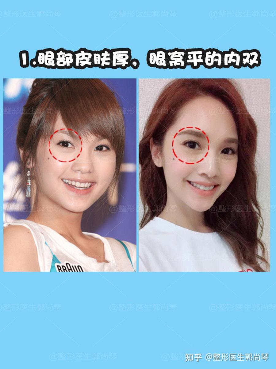 1 眼部皮肤厚,眼窝平的内双上期讲了骨相耐