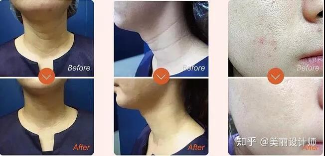 什么是基因断裂 v2-31df72683e38d3a1a4dececfb31014a5_r.jpg