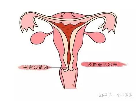 原发性痛经,一般与女性内分泌失调,子宫发育不良,子宫颈狭窄,子宫过度