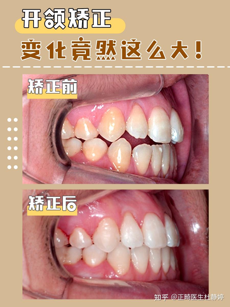 开颌矫正变化竟然这么大