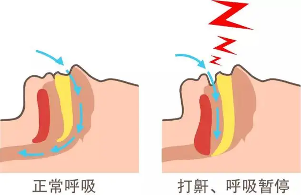 呼吸机治疗鼾症在国内为什么没有得到普及? - 知乎