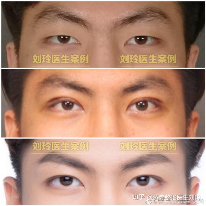 男生割双眼皮前后对比是什么体验