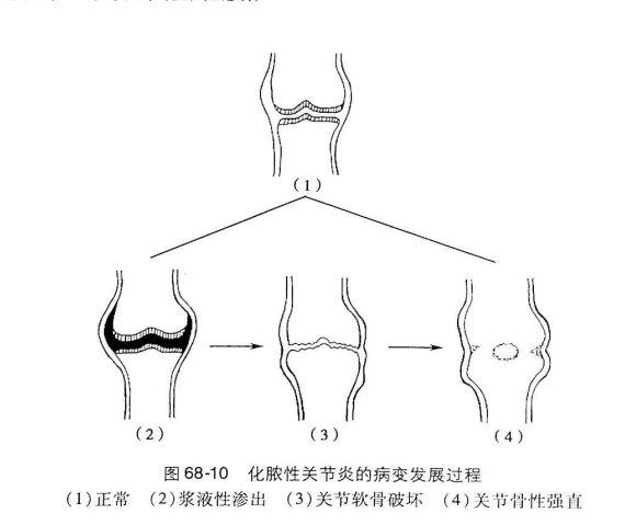 化脓性关节炎的病变发展过程分为三个阶段(浆液性渗出期—浆液纤维素