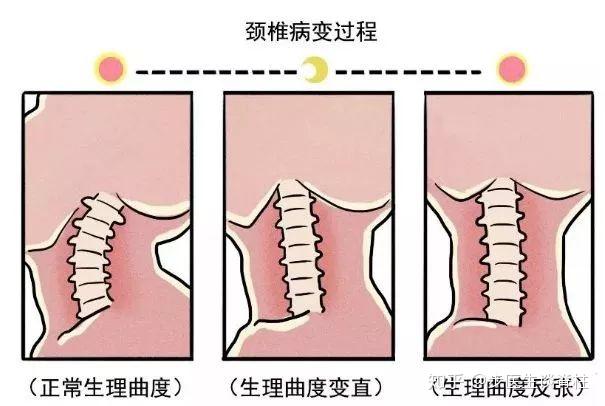 正中脊有問必答頸椎生理曲度變直你中招了嗎