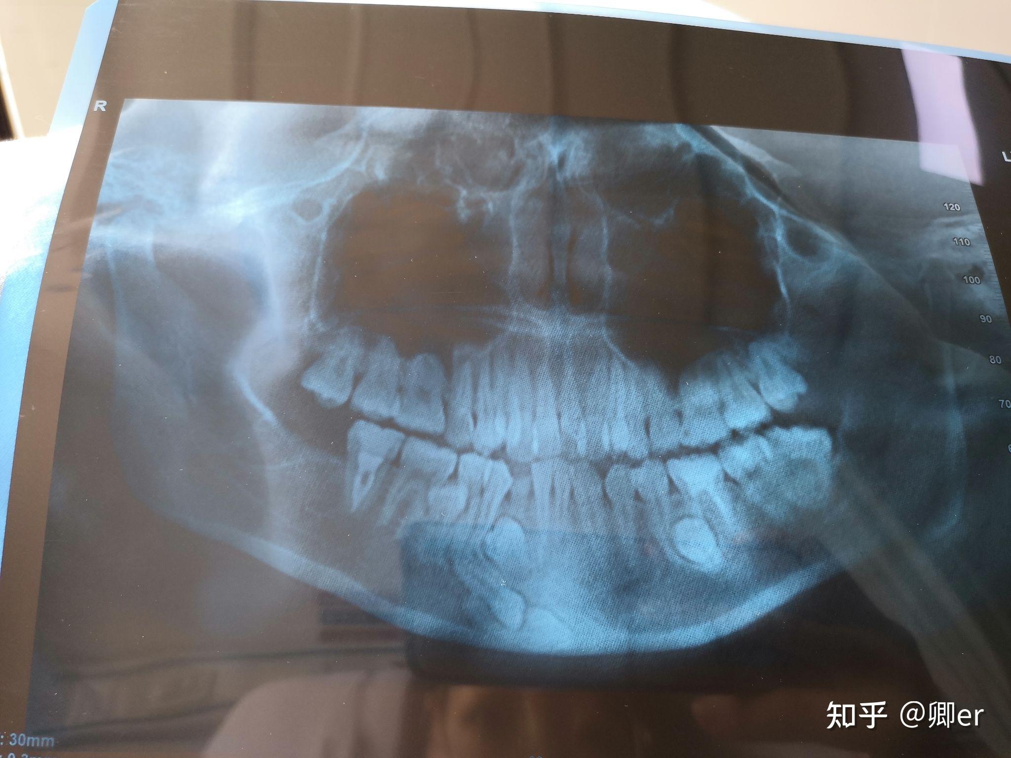 下頜骨囊腫伴多生牙埋伏牙手術碎碎念